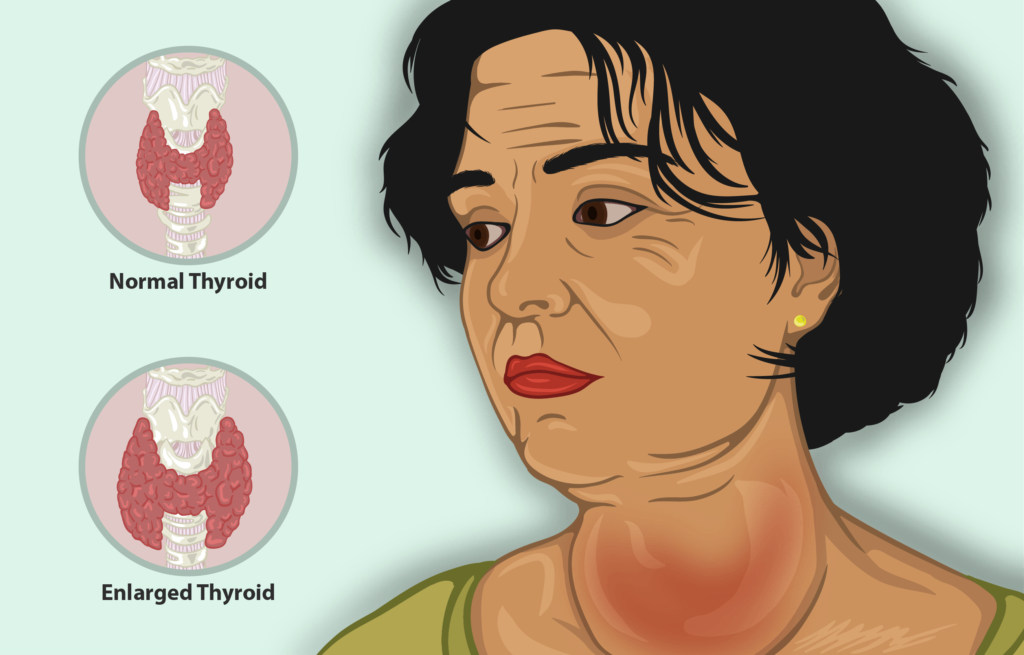goiter - iodine deficiency disorder